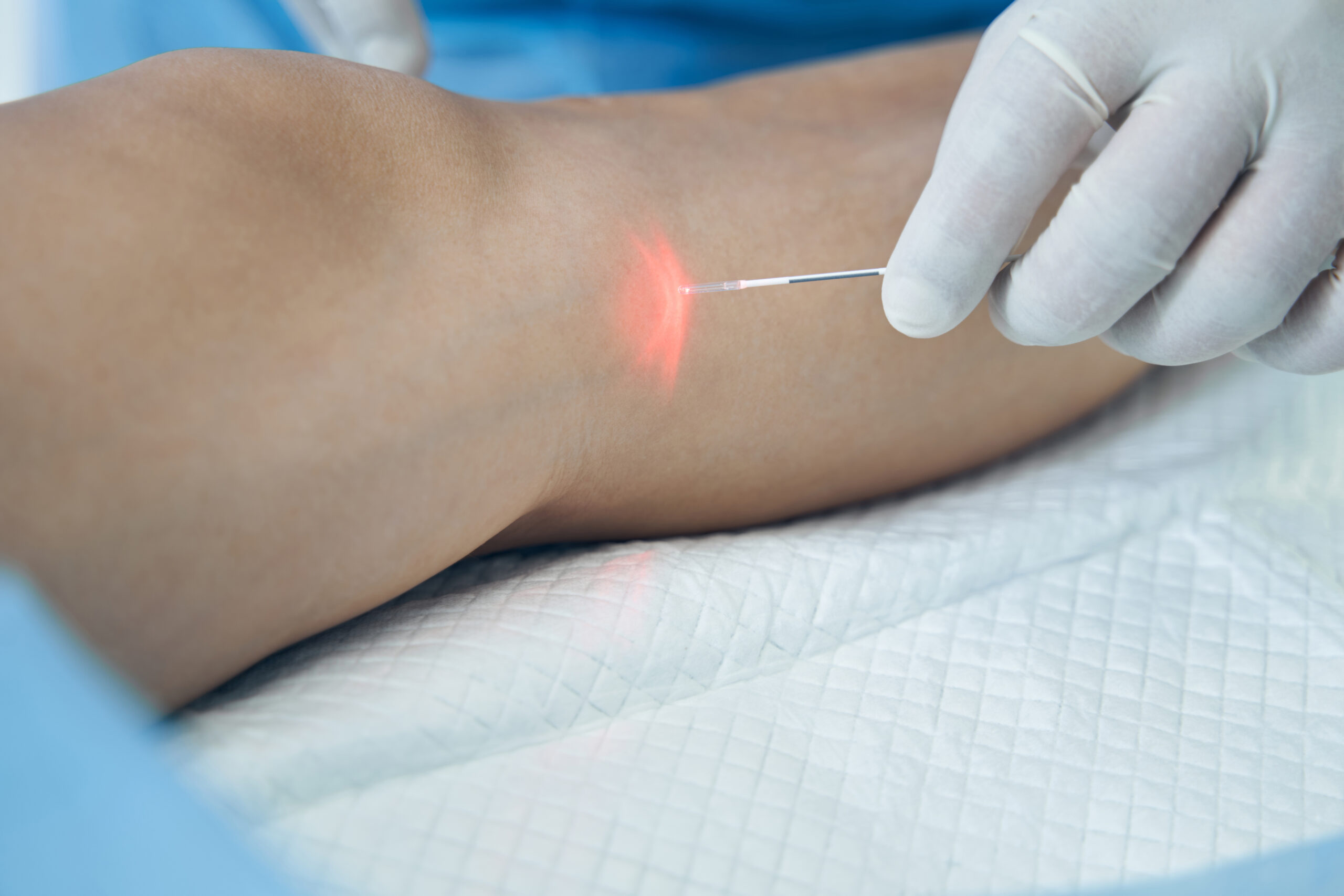 Endovenous laser treatment of the leg vein in hospital