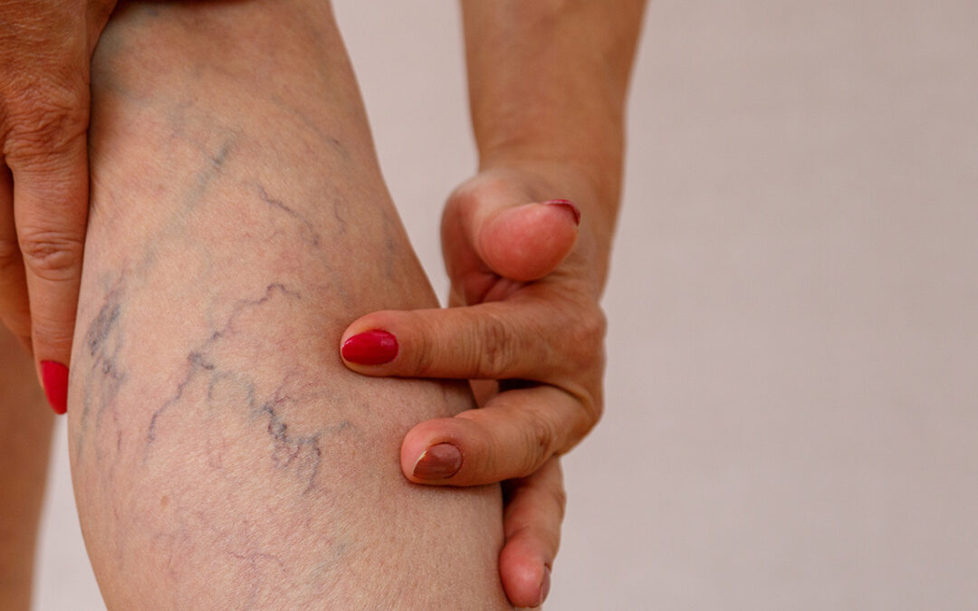 Why That Discoloration in Your Legs Can’t Be Ignored