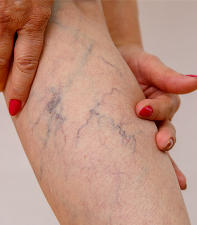 An elderly woman in white panties is touching her legs with cellulite and varicose veins on a light isolated background. Concept for medicine and cosmetology.