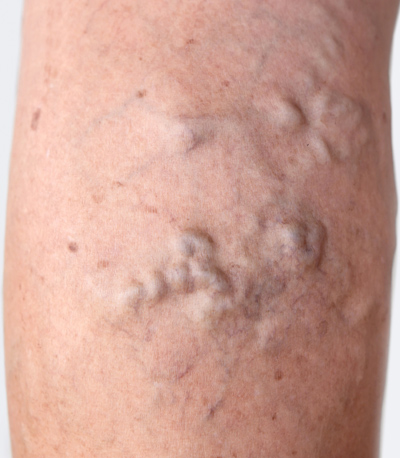 varicose veins on female leg skin closeup